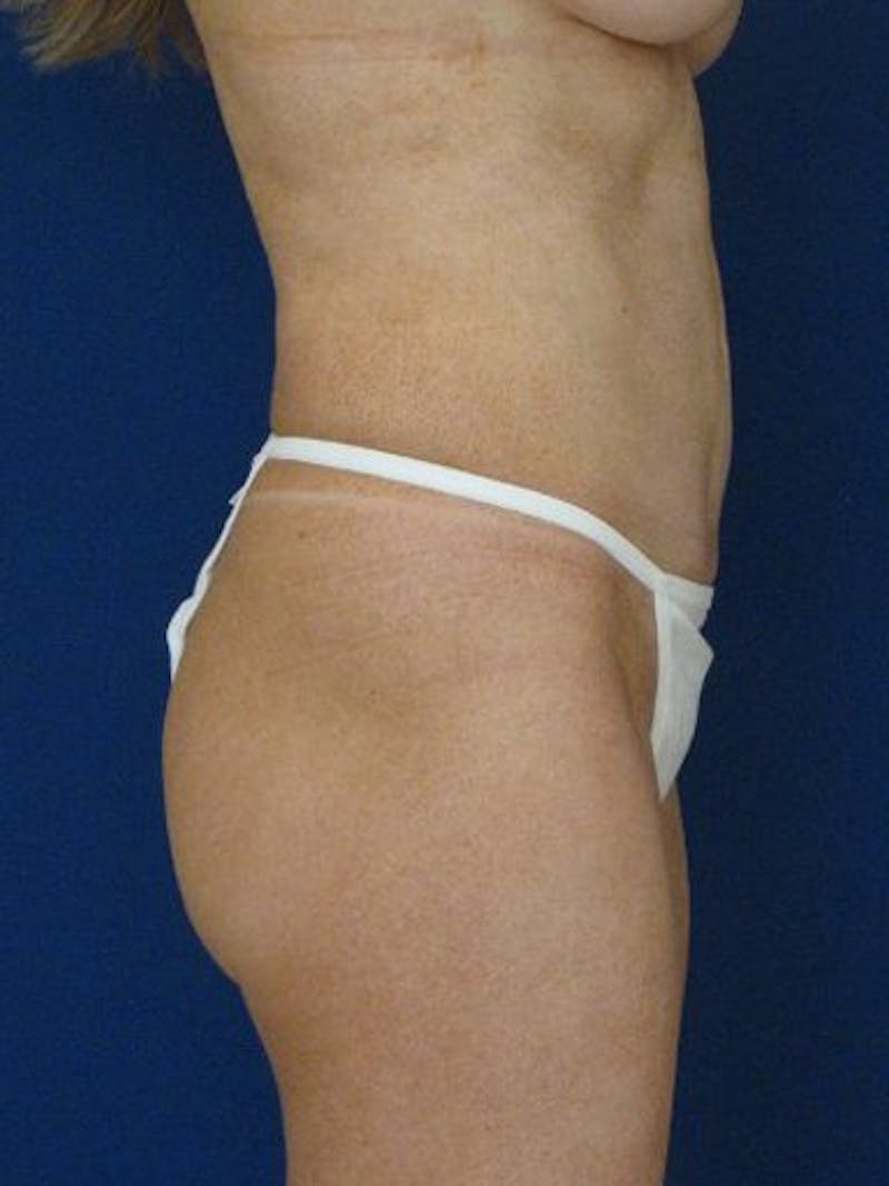 Female Hi-Def Liposuction Before & After Gallery - Patient 18260508 - Image 3