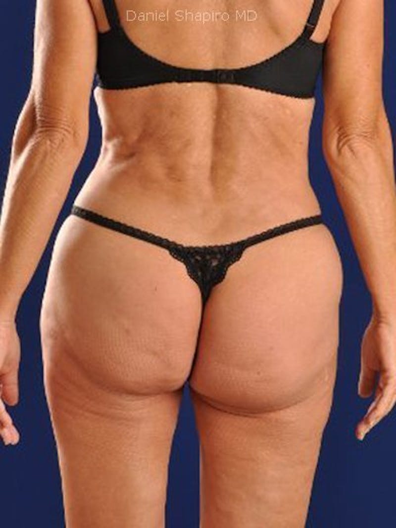 Female Hi-Def Liposuction Before & After Gallery - Patient 18262201 - Image 6