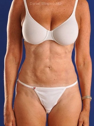Female Hi-Def Liposuction Before & After Gallery - Patient 18262203 - Image 2