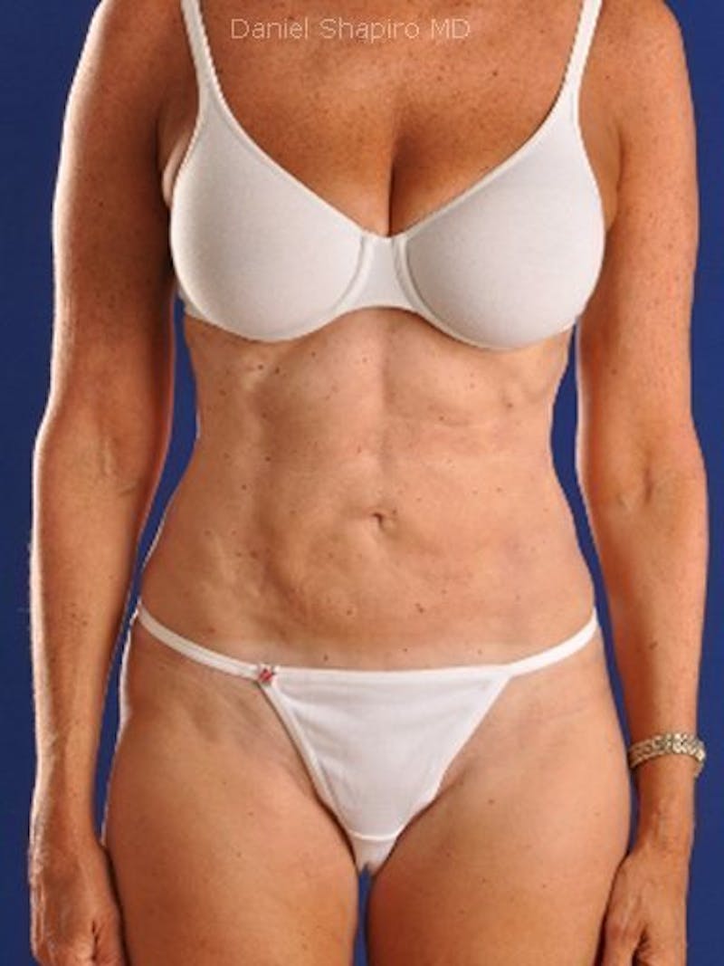 Female Hi-Def Liposuction Before & After Gallery - Patient 18262203 - Image 2