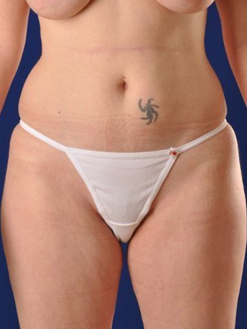 Female Hi-Def Liposuction Before & After Gallery - Patient 18262204 - Image 1