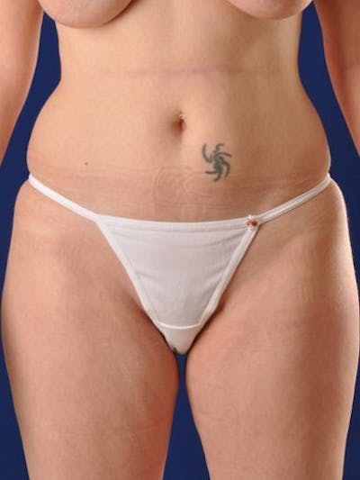 Female Hi-Def Liposuction Before & After Gallery - Patient 18262204 - Image 1