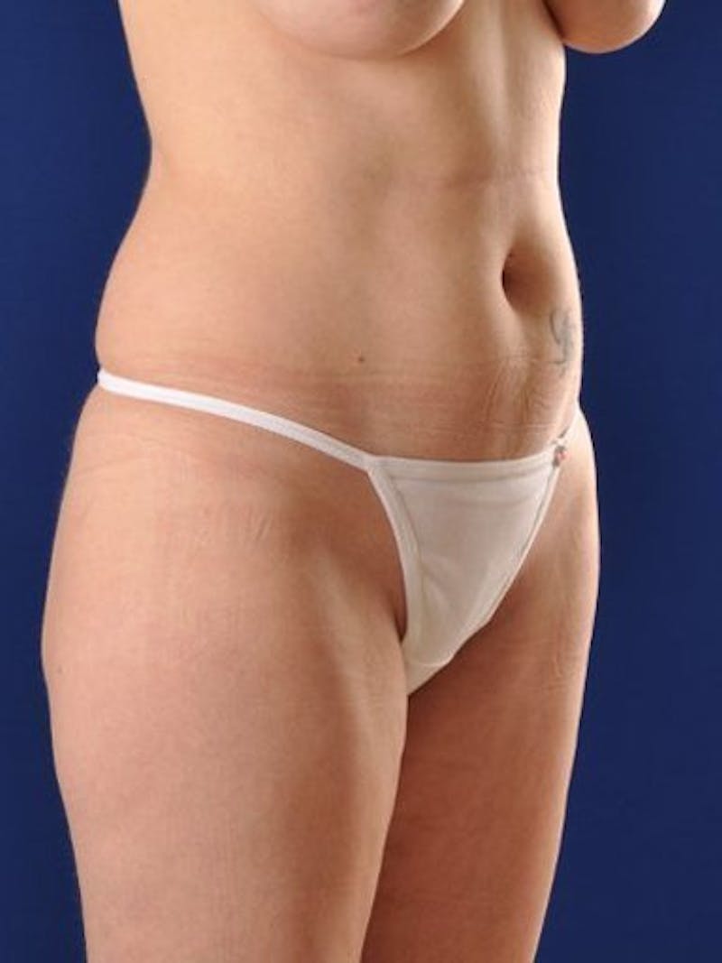 Female Hi-Def Liposuction Before & After Gallery - Patient 18262204 - Image 3