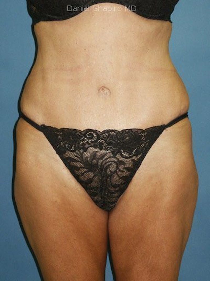 Female Hi-Def Liposuction Before & After Gallery - Patient 18262207 - Image 2