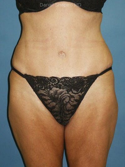 Female Hi-Def Liposuction Before & After Gallery - Patient 18262207 - Image 2
