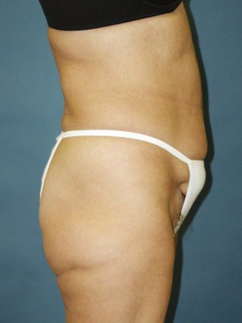 Female Hi-Def Liposuction Before & After Gallery - Patient 18262207 - Image 3