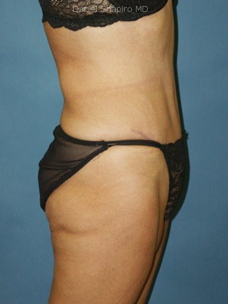 Female Hi-Def Liposuction Before & After Gallery - Patient 18262207 - Image 4