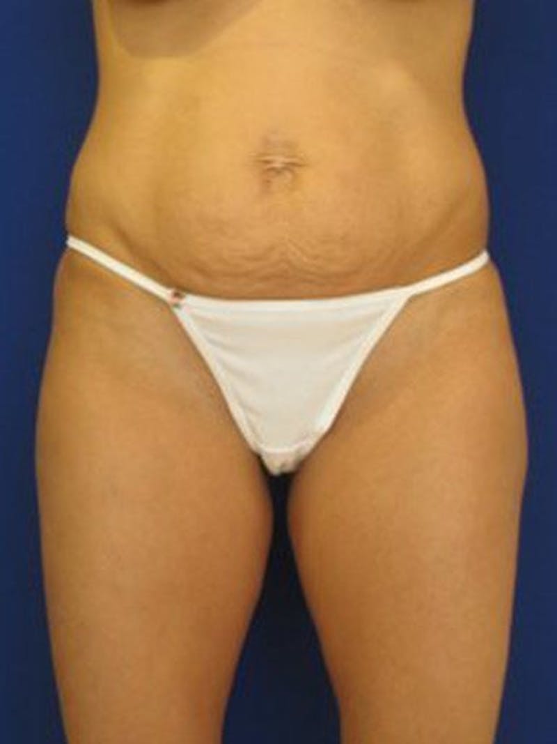 Female Hi-Def Liposuction Before & After Gallery - Patient 18262210 - Image 1