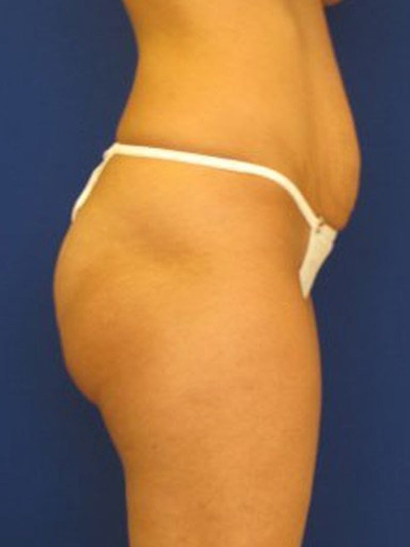 Female Hi-Def Liposuction Before & After Gallery - Patient 18262210 - Image 3