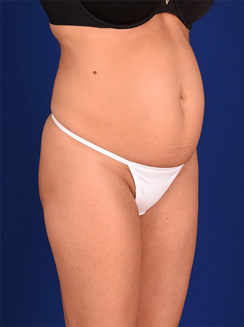 Abdominoplasty / Tummy Tuck Before & After Gallery - Patient 18264480 - Image 3