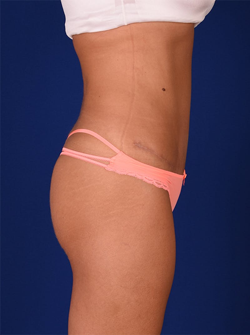 Abdominoplasty / Tummy Tuck Before & After Gallery - Patient 18264480 - Image 6