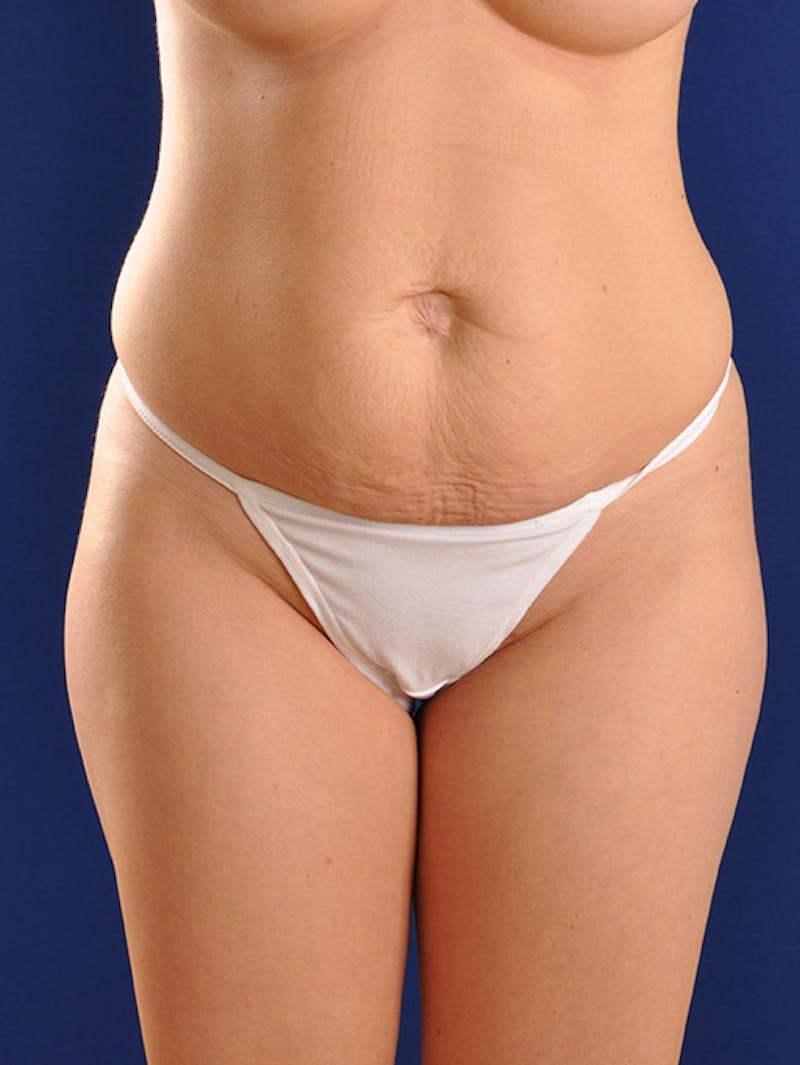 Abdominoplasty / Tummy Tuck Before & After Gallery - Patient 18264482 - Image 1