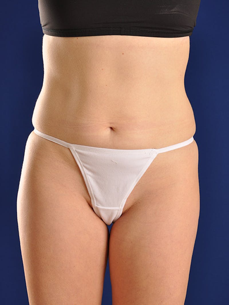 Abdominoplasty / Tummy Tuck Before & After Gallery - Patient 18264489 - Image 1