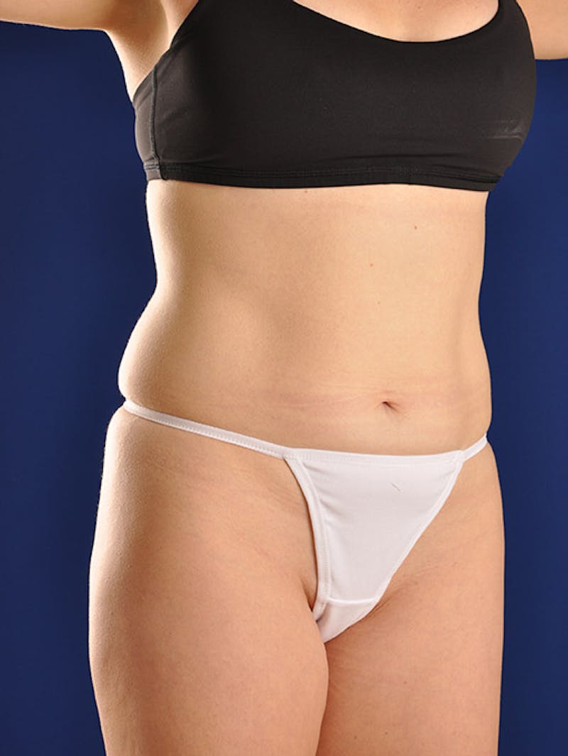 Abdominoplasty / Tummy Tuck Before & After Gallery - Patient 18264489 - Image 3