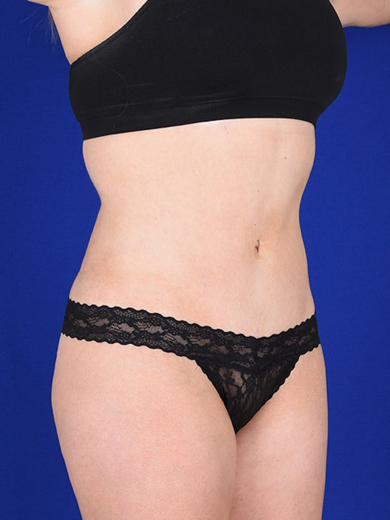 Abdominoplasty / Tummy Tuck Before & After Gallery - Patient 18264489 - Image 4