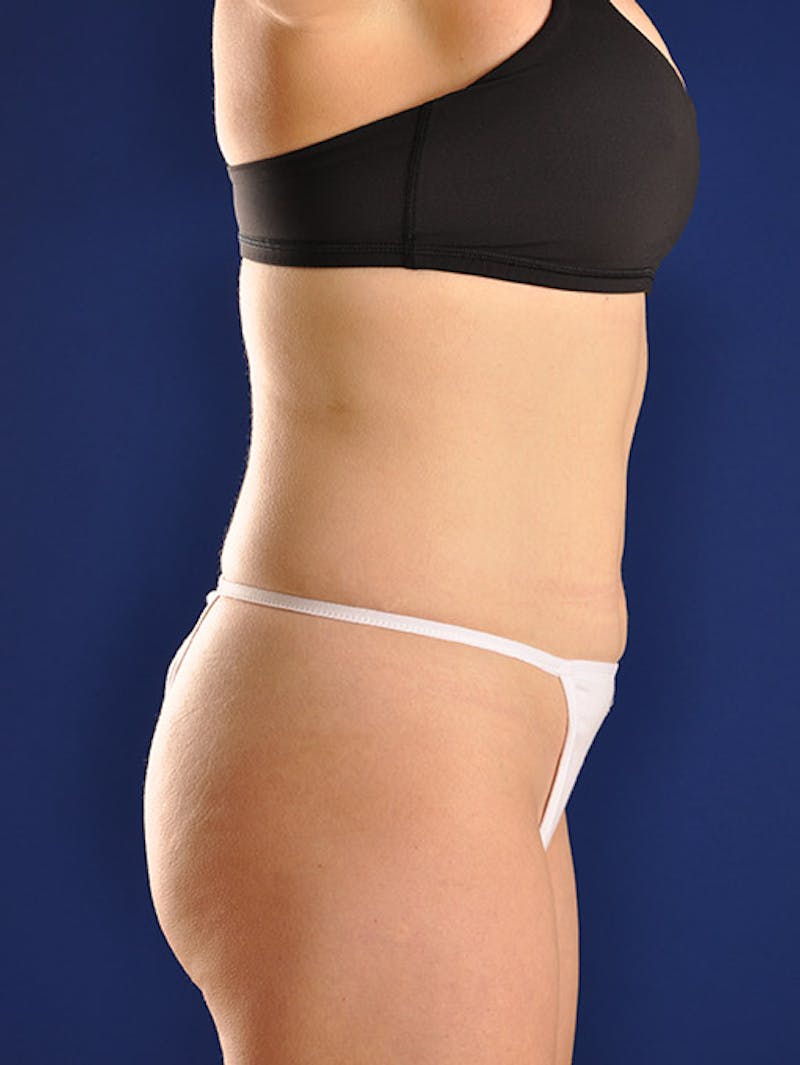 Abdominoplasty / Tummy Tuck Before & After Gallery - Patient 18264489 - Image 5