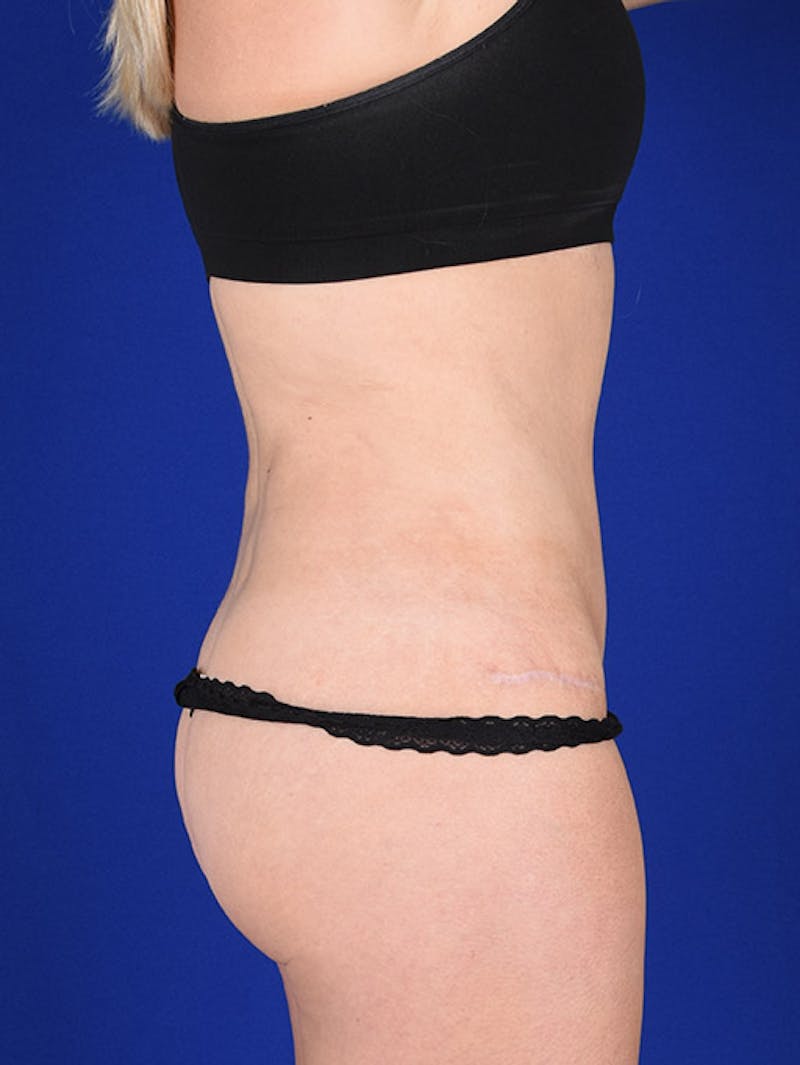 Abdominoplasty / Tummy Tuck Before & After Gallery - Patient 18264489 - Image 6