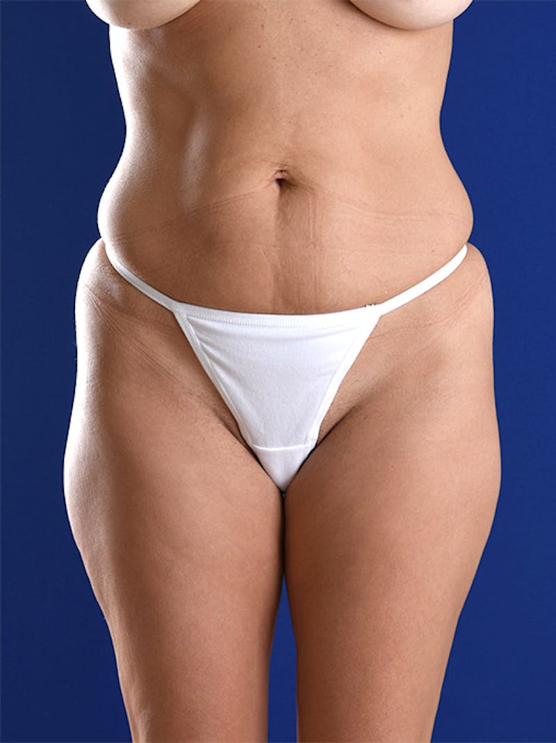 Abdominoplasty / Tummy Tuck Before & After Gallery - Patient 18264494 - Image 1