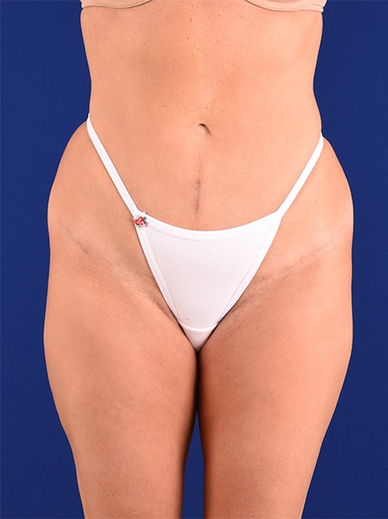 Abdominoplasty / Tummy Tuck Before & After Gallery - Patient 18264494 - Image 2