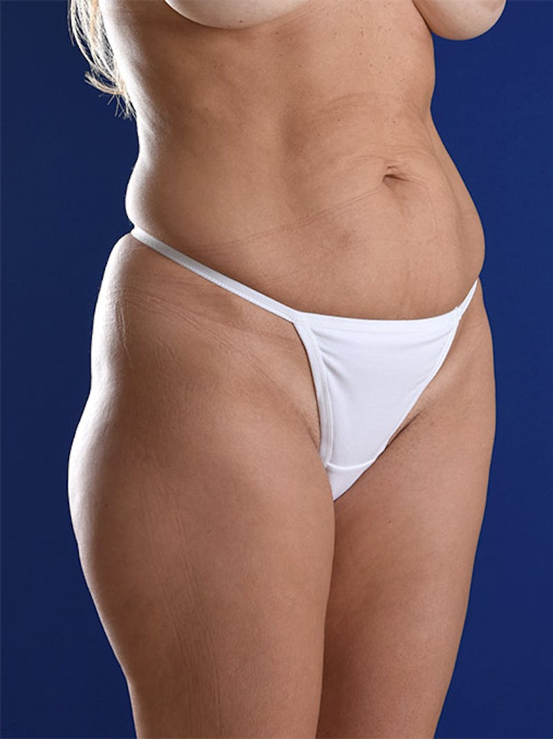 Abdominoplasty / Tummy Tuck Before & After Gallery - Patient 18264494 - Image 3