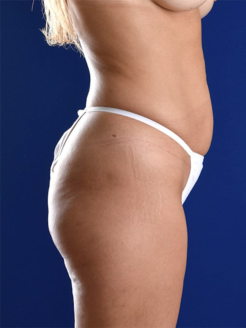 Abdominoplasty / Tummy Tuck Before & After Gallery - Patient 18264494 - Image 5