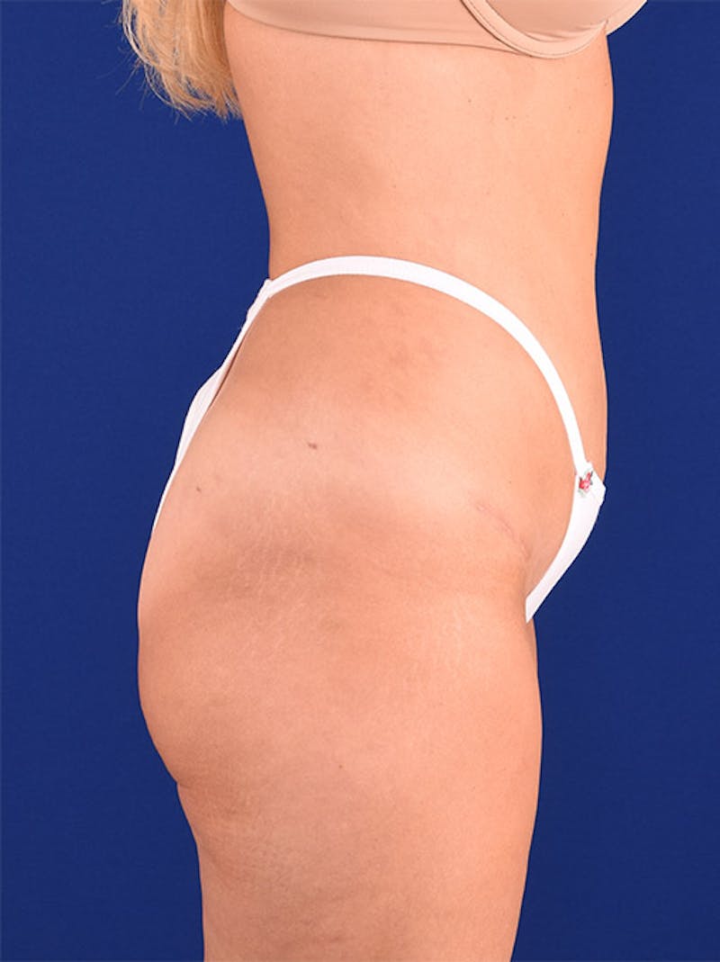 Abdominoplasty / Tummy Tuck Before & After Gallery - Patient 18264494 - Image 6