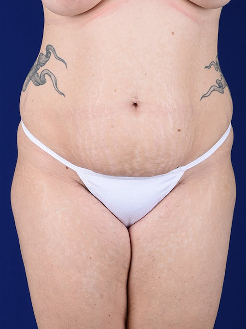 Abdominoplasty / Tummy Tuck Before & After Gallery - Patient 18264498 - Image 1