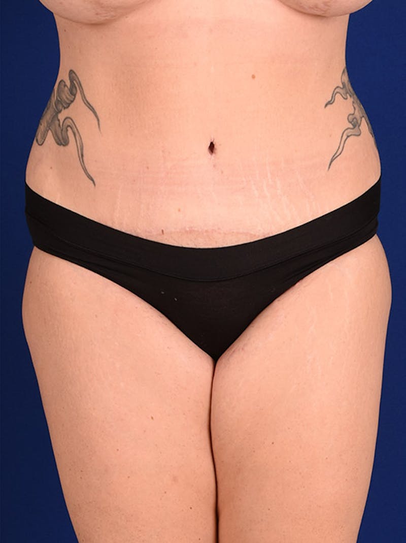 Abdominoplasty / Tummy Tuck Before & After Gallery - Patient 18264498 - Image 2