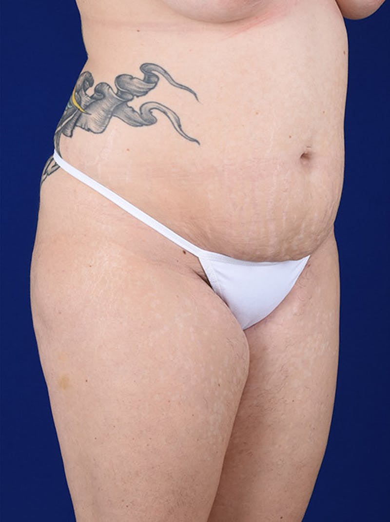 Abdominoplasty / Tummy Tuck Before & After Gallery - Patient 18264498 - Image 3