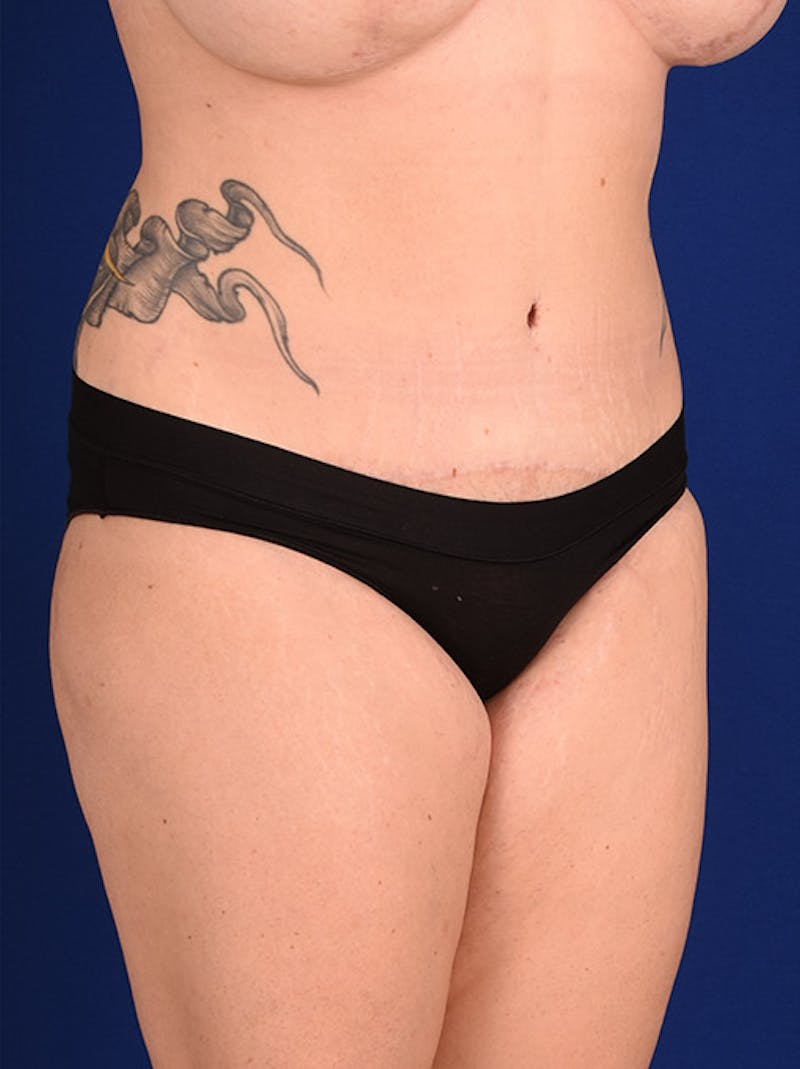 Abdominoplasty / Tummy Tuck Before & After Gallery - Patient 18264498 - Image 4