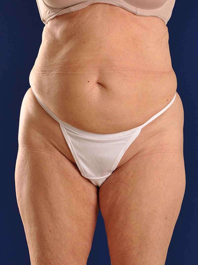 Abdominoplasty / Tummy Tuck Before & After Gallery - Patient 18264501 - Image 1