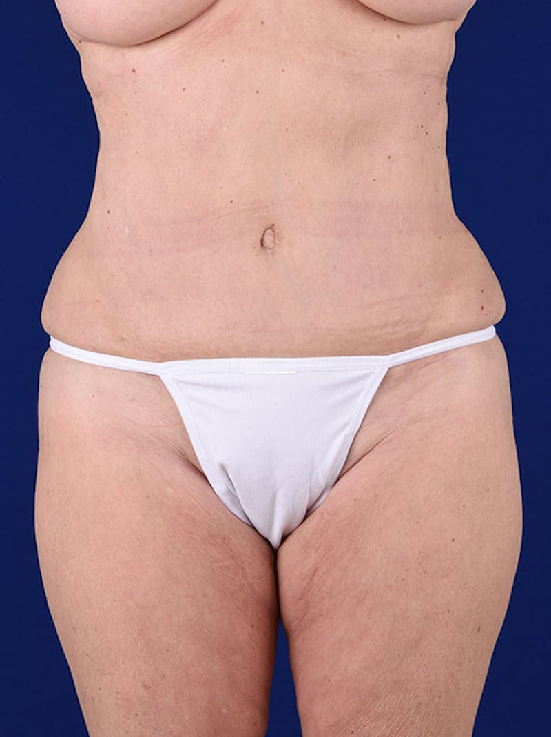 Abdominoplasty / Tummy Tuck Before & After Gallery - Patient 18264501 - Image 2