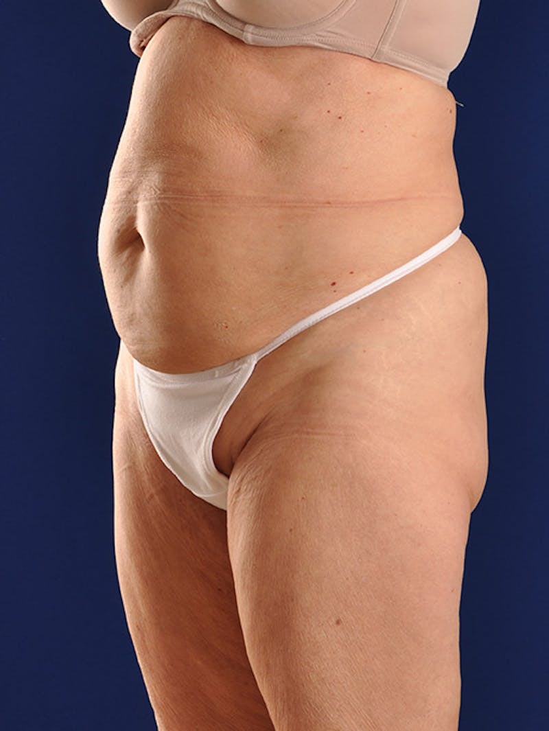 Abdominoplasty / Tummy Tuck Before & After Gallery - Patient 18264501 - Image 3