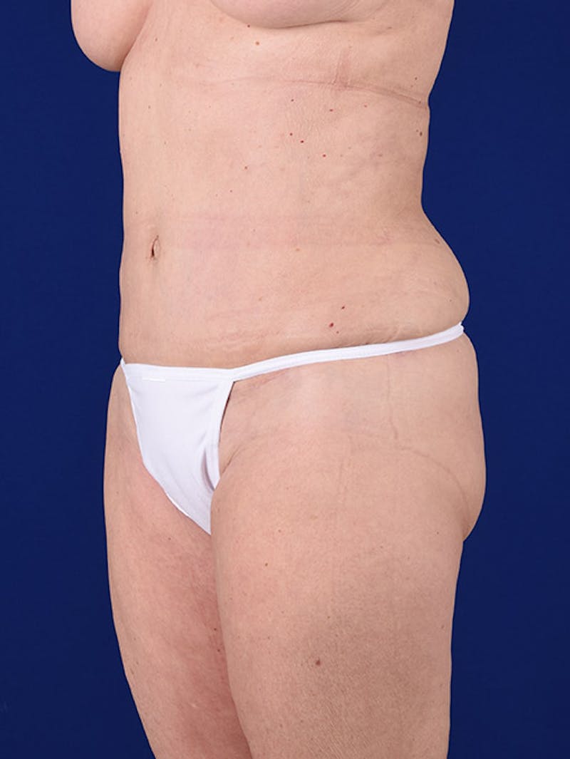 Abdominoplasty / Tummy Tuck Before & After Gallery - Patient 18264501 - Image 4