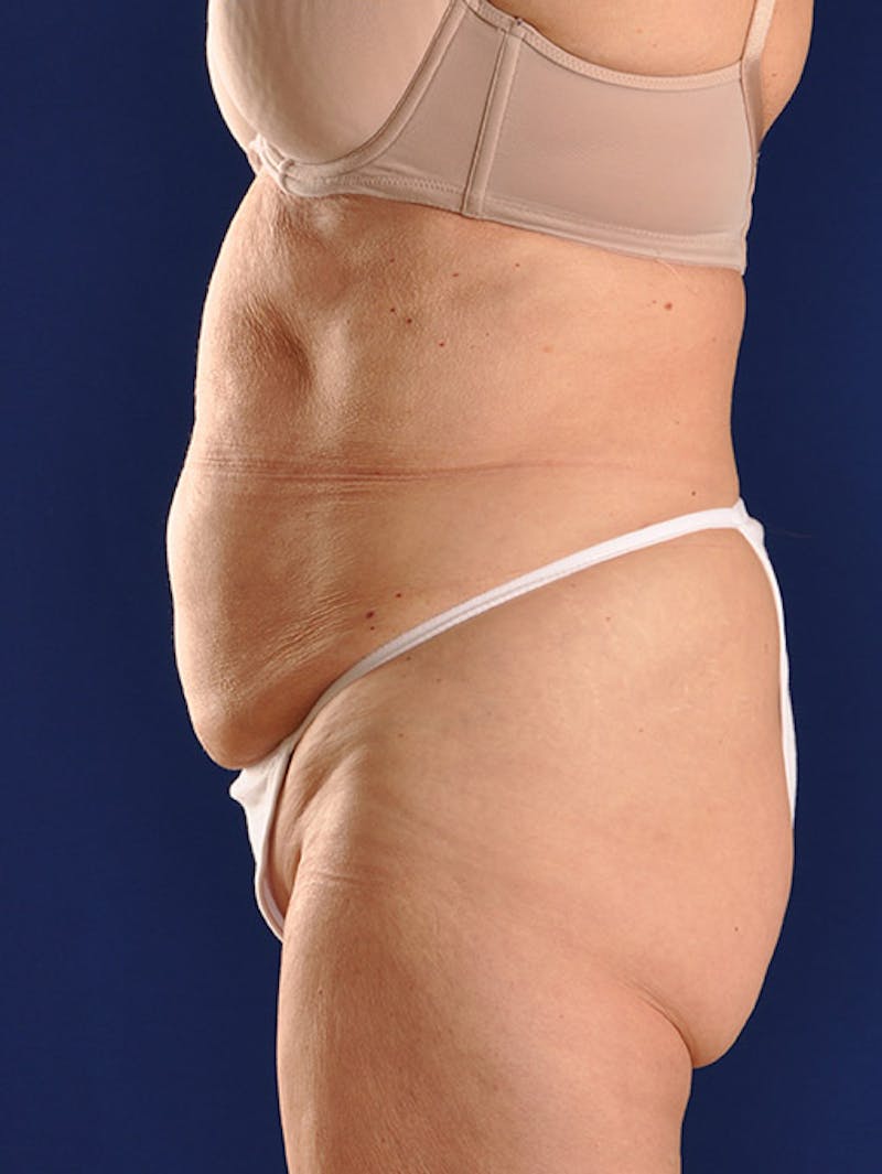 Abdominoplasty / Tummy Tuck Before & After Gallery - Patient 18264501 - Image 5
