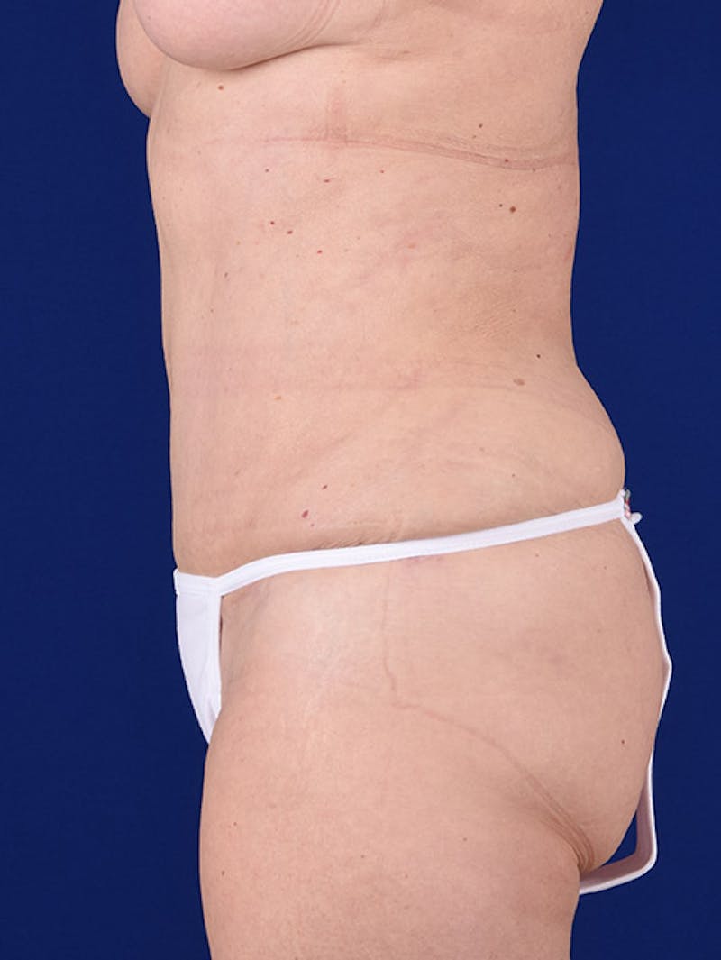 Abdominoplasty / Tummy Tuck Before & After Gallery - Patient 18264501 - Image 6