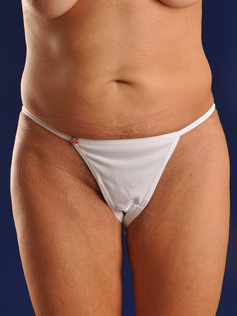 Abdominoplasty / Tummy Tuck Before & After Gallery - Patient 18264504 - Image 1