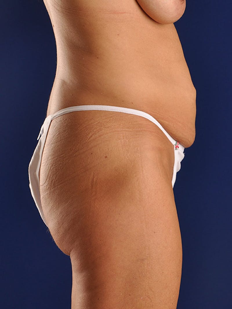 Abdominoplasty / Tummy Tuck Before & After Gallery - Patient 18264504 - Image 5