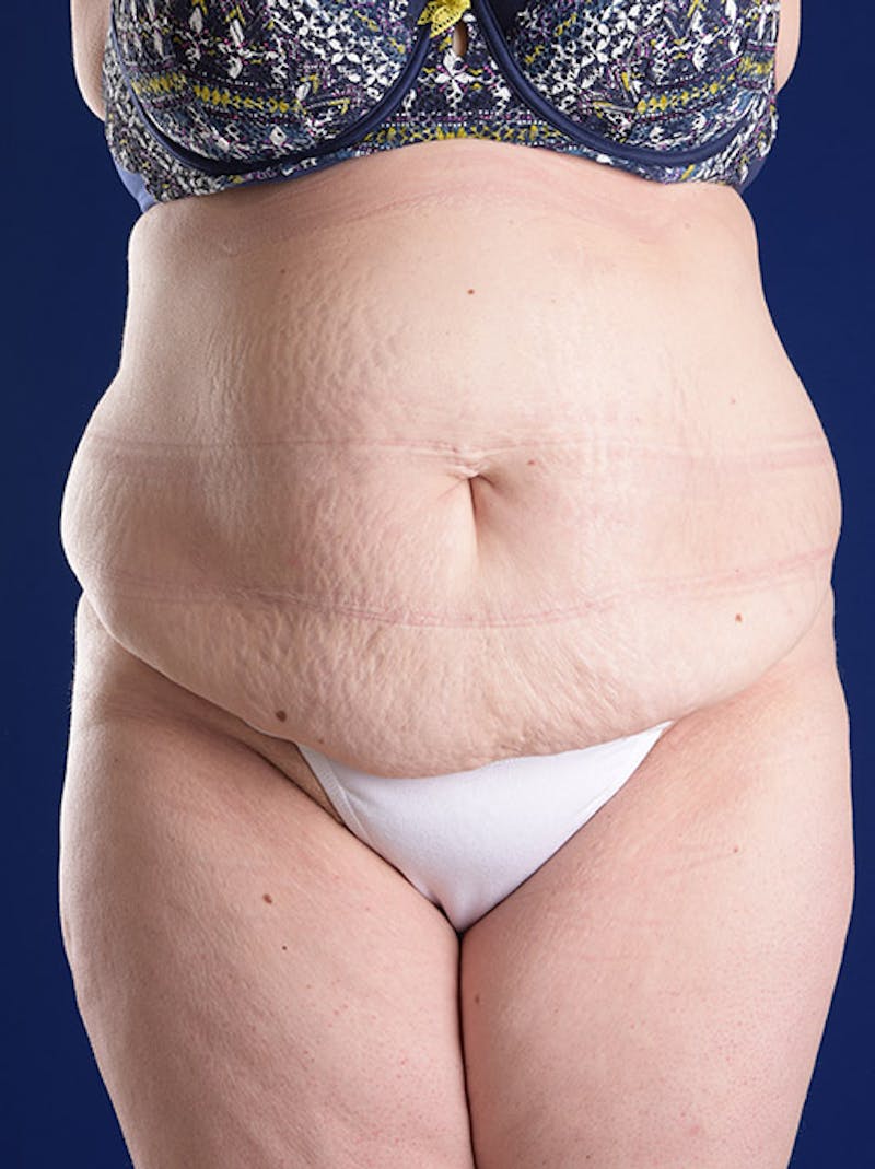 Abdominoplasty / Tummy Tuck Before & After Gallery - Patient 18264514 - Image 1
