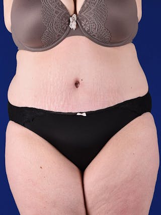 Abdominoplasty / Tummy Tuck Before & After Gallery - Patient 18264514 - Image 2
