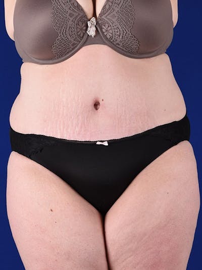 Abdominoplasty / Tummy Tuck Before & After Gallery - Patient 18264514 - Image 2