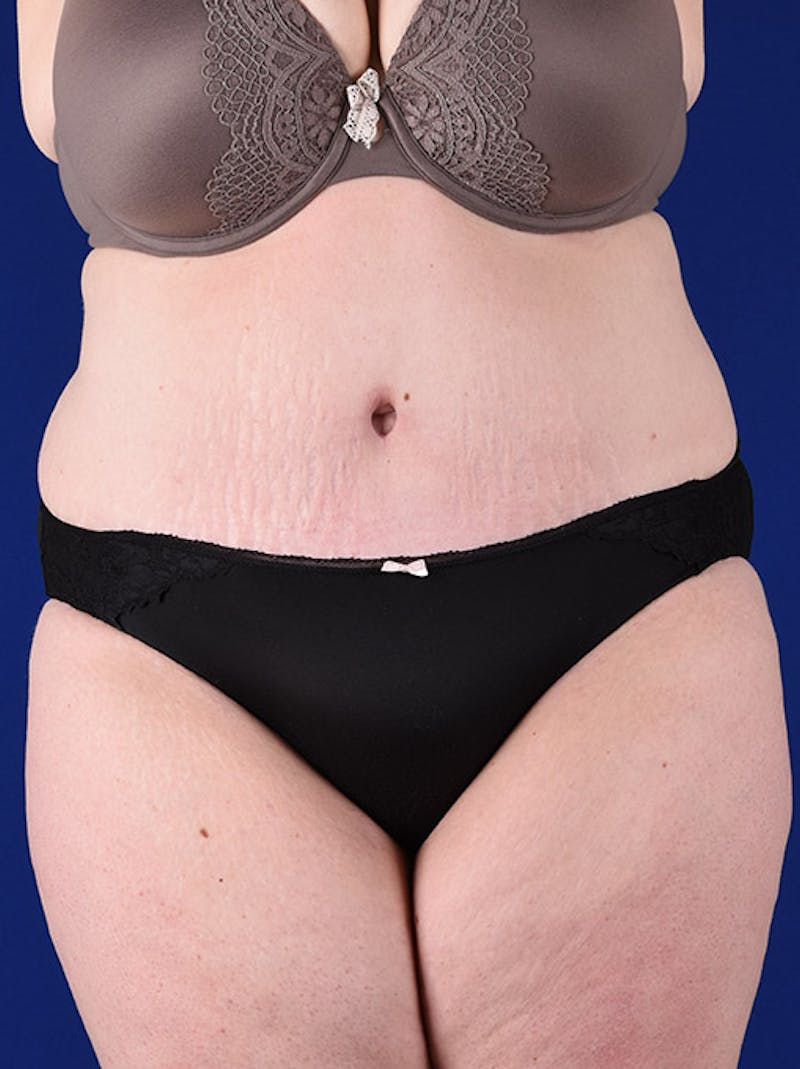 Abdominoplasty / Tummy Tuck Before & After Gallery - Patient 18264514 - Image 2