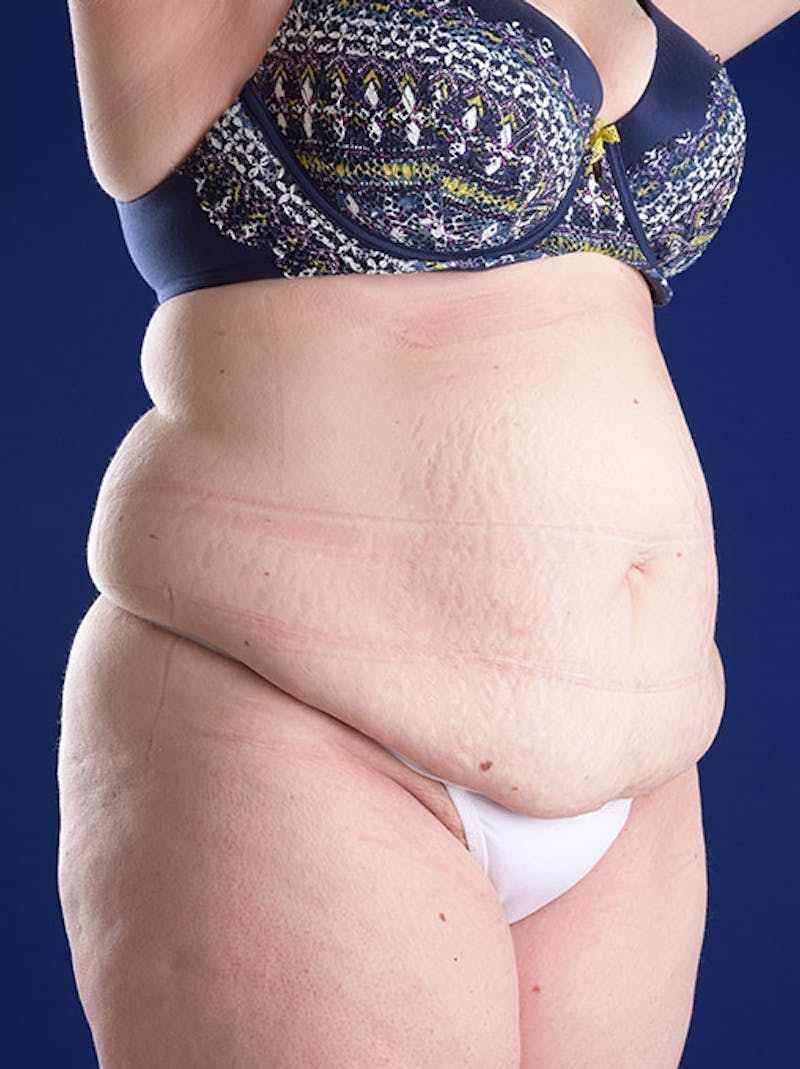 Abdominoplasty / Tummy Tuck Before & After Gallery - Patient 18264514 - Image 3