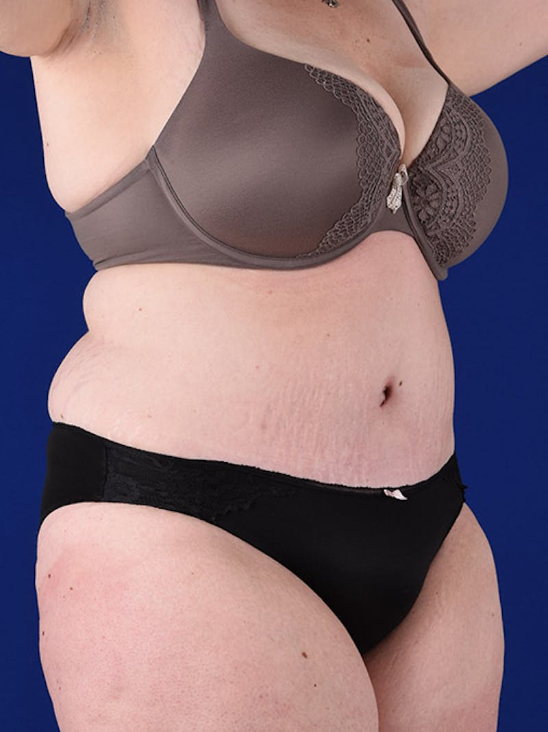 Abdominoplasty / Tummy Tuck Before & After Gallery - Patient 18264514 - Image 4
