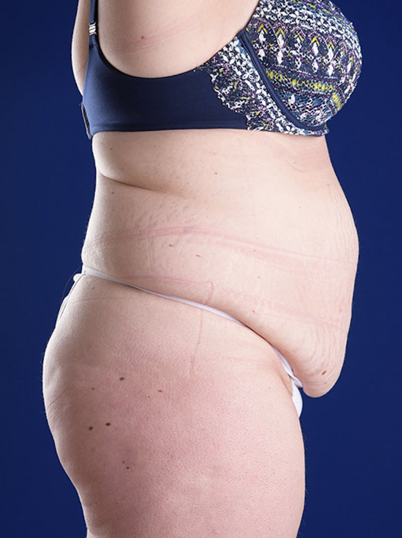 Abdominoplasty / Tummy Tuck Before & After Gallery - Patient 18264514 - Image 5