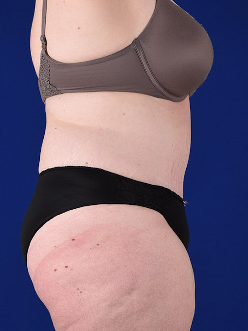 Abdominoplasty / Tummy Tuck Before & After Gallery - Patient 18264514 - Image 6