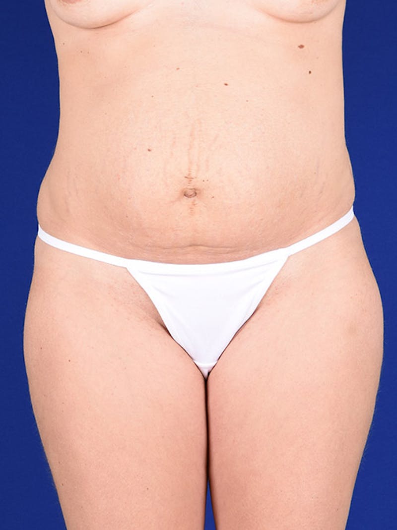 Abdominoplasty / Tummy Tuck Before & After Gallery - Patient 18264519 - Image 1