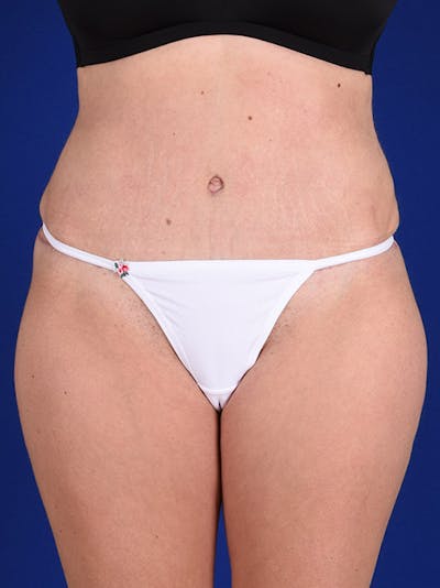 Abdominoplasty / Tummy Tuck Before & After Gallery - Patient 18264519 - Image 2