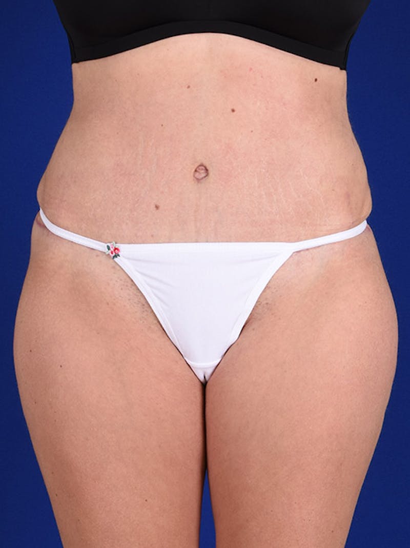 Abdominoplasty / Tummy Tuck Before & After Gallery - Patient 18264519 - Image 2