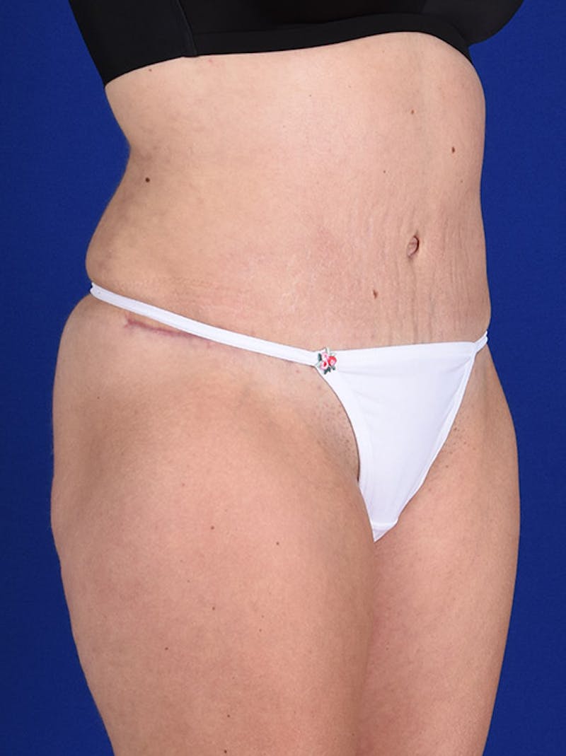 Abdominoplasty / Tummy Tuck Before & After Gallery - Patient 18264519 - Image 4